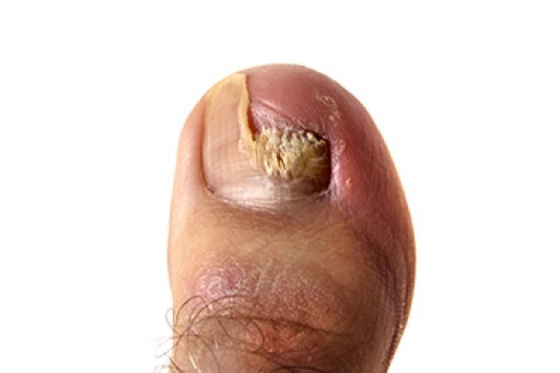 Understanding Toenail Fungus Infections