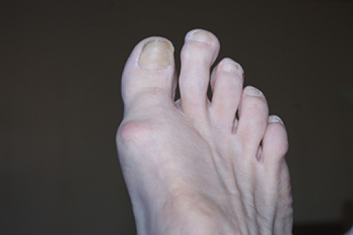 Toe Pain