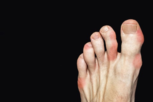 Everything You Need to Know About Gout