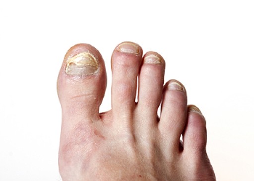 Understanding Toenail Fungus