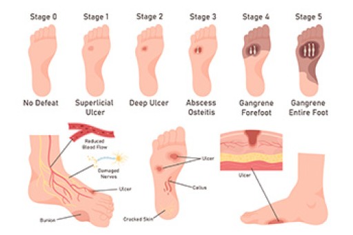 Diabetic Foot Care