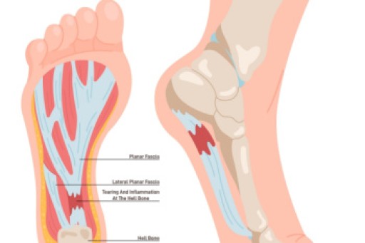 Finding Relief From Plantar Fasciitis Pain