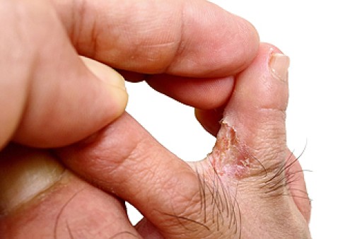 Understanding and Preventing Athlete’s Foot