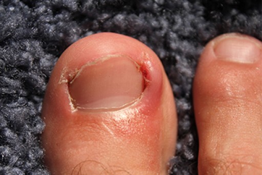 Ingrown Toenails