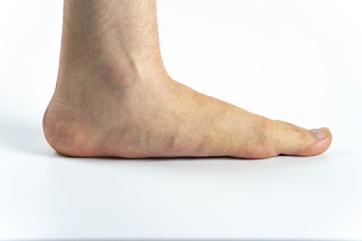 When Flat Feet Cause Pain