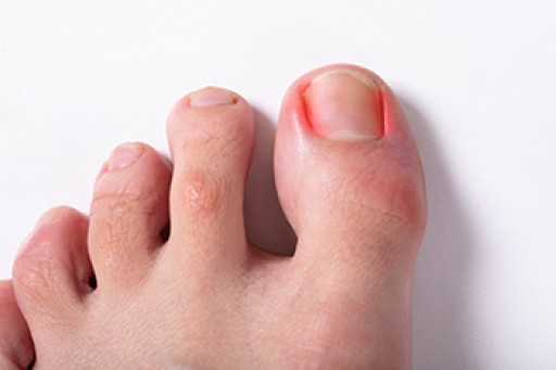 What Can I Do About Ingrown Toenails?
