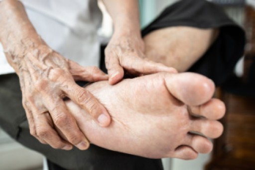 Rheumatoid Arthritis in the Feet