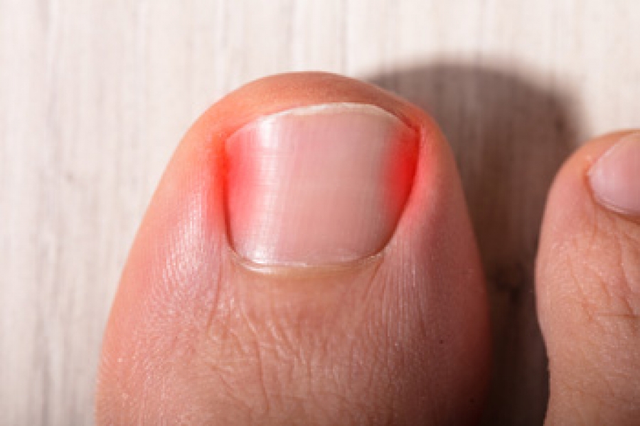 Can Babies Develop Ingrown Toenails?